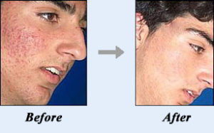 acne no more