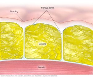 cellulite causes