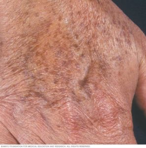 age spots on hands